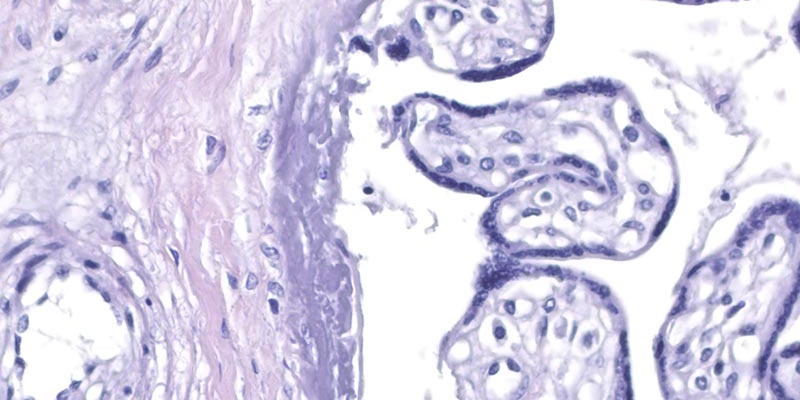 caso-2-2065-15-placenta